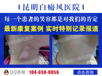 昆明哪个医院治白癜风好