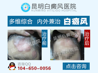 昆明看白癜风医院哪家效果好
