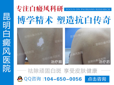昆明治疗白癜风哪个医院比较好