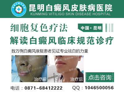 导致白癜风复发有哪些外在因素