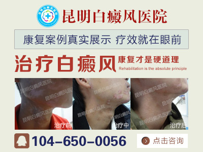 白癜风都有哪些症状表现