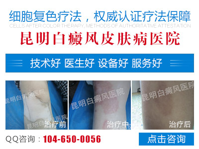 神经性白癜风有哪些症状