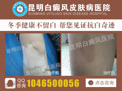中医拔火罐是否可以治疗白癜风