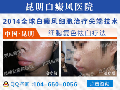 醋对白癜风有影响吗