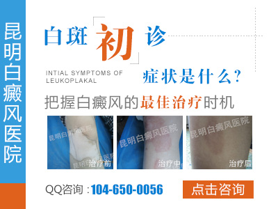 治疗白癜风应该知道哪些事